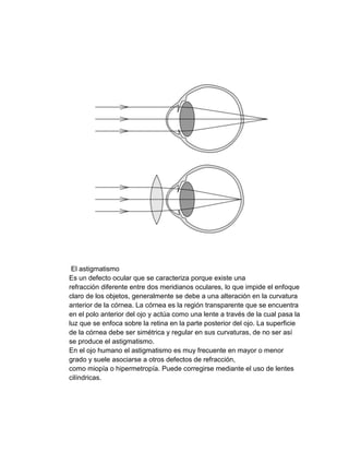 El astigmatismo
Es un defecto ocular que se caracteriza porque existe una
refracción diferente entre dos meridianos oculares, lo que impide el enfoque
claro de los objetos, generalmente se debe a una alteración en la curvatura
anterior de la córnea. La córnea es la región transparente que se encuentra
en el polo anterior del ojo y actúa como una lente a través de la cual pasa la
luz que se enfoca sobre la retina en la parte posterior del ojo. La superficie
de la córnea debe ser simétrica y regular en sus curvaturas, de no ser así
se produce el astigmatismo.
En el ojo humano el astigmatismo es muy frecuente en mayor o menor
grado y suele asociarse a otros defectos de refracción,
como miopía o hipermetropía. Puede corregirse mediante el uso de lentes
cilíndricas.

 