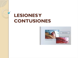 PRESENTACION LESIONES Y CONTUSIONES.pptx