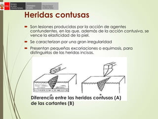 Heridas contusas
 Son lesiones producidas por la acción de agentes
contundentes, en las que, además de la acción contusiva, se
vence la elasticidad de la piel.
 Se caracterizan por una gran irregularidad
 Presentan pequeñas excoriaciones o equimosis, para
distinguirlas de las heridas incisas.
Diferencia entre las heridas contusas (A)
de las cortantes (B)
 