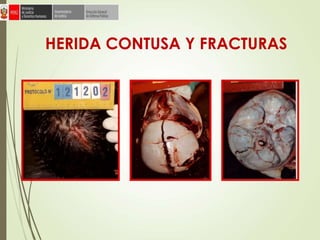 HERIDA CONTUSA Y FRACTURAS
 