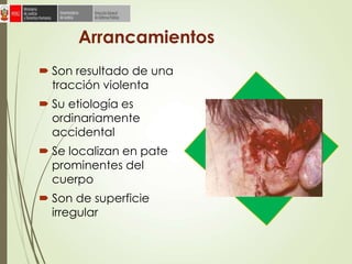 Arrancamientos
 Son resultado de una
tracción violenta
 Su etiología es
ordinariamente
accidental
 Se localizan en pate
prominentes del
cuerpo
 Son de superficie
irregular
 