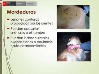 Mordeduras
 Lesiones contusas
producidas por los dientes
 Pueden causarlas
animales o el hombre
 Pueden ir desde simples
excoriaciones o equimosis
hasta arrancamientos
 