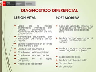 DIAGNOSTICO DIFERENCIAL
LESION VITAL
 Labio de la herida:
engrosados, infiltrados con
sangre, endurecidos .
Aplanados, exudación de linfa
y supuración.
 Hemorragia abundante, con
infiltracion de sangre en los
tejidos .
 Sangre coagulada en el fondo
de la herida o piel
 Leucocitosis traumática
 Cambios en la hemoglobina
 Cambios en la trama capilar
 Cambios en el tejido
conjuntivo
 Necrosis de los bordes
POST MORTEM
 Labio de la herida blando, no
engrosados, no retraídos, con
ausencia de exudación de
linfa
 No hay hemorragia arterial , ni
venosa, ni infiltración de
sangre
 No hay sangre coagulada o
solo coagulo incompleto
 Escasos leucocitos.
 No hay cambios en la Hb.
 Sin cambios
 sin cambios-
 