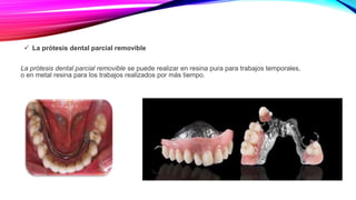  La prótesis dental parcial removible
La prótesis dental parcial removible se puede realizar en resina pura para trabajos temporales,
o en metal resina para los trabajos realizados por más tiempo.
 