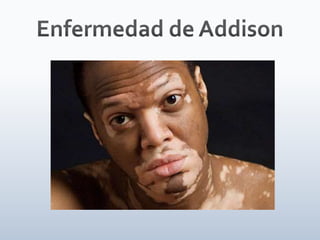 Tiroides, paratiroides, Glandulas suprarenales