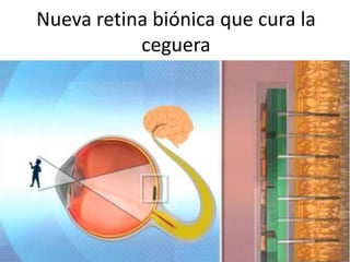 Nueva retina biónica que cura la
ceguera
 