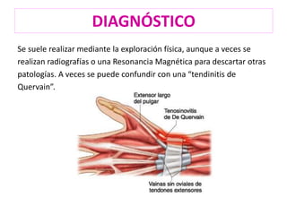 DIAGNÓSTICO 
Se suele realizar mediante la exploración física, aunque a veces se 
realizan radiografías o una Resonancia Magnética para descartar otras 
patologías. A veces se puede confundir con una “tendinitis de 
Quervain”. 
 