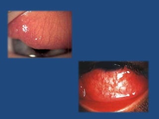 Conjuntivitis víricaExploración Edema palpebral.