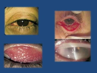  Ojo rojo vascular  con patrón difuso sin predominio por l tercio inferior mixto (conjuntival y periquerático).Tratamiento Sintomático con compresa frías sobre los ojos.