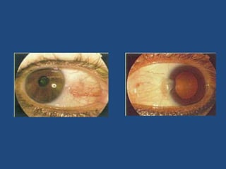Antihistamínicos (azelastina o levocabastina).