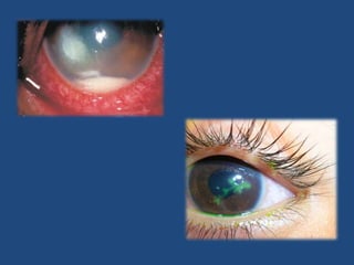 PterigionPliegue conjuntival anormal de aspecto triangular, con el vértice hacia la cornea hasta el área pupilar.Tratamientos:Colirios antiinflatorios.