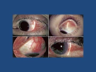 Queratitis Etiología variada: bacterias, virus, hongos,  quemaduras químicas, soldaduras, cuerpos extraños, etc. Clínica más llamativa que en las conjuntivitis, con dolor y fotofobia. Excepción la queratitis herpética  habitualmente poco sintomática.