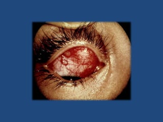 Ojo rojo vascular con un patrón difuso de predominio ciliar.