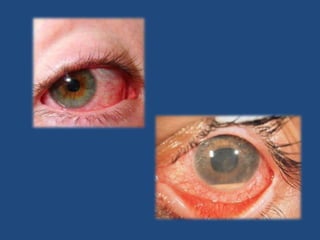 EscleritisLa esclera es la parte blanca del ojo.Más rara y más sintomática que la epiescleritis.Dolor intenso, lagrimeo, fotofobia y visión borrosa.Ojo rojo vascular con inyección mixta, de tonalidad azulada.Derivar a oftalmología con urgencia.