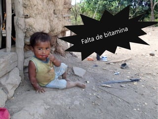 Falta de bitamina
 