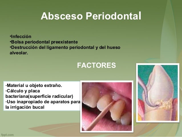 patologia absceso periodontal absceso dental