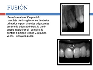 FUSIÓN
Se reﬁere a la unión parcial o
completa de dos gérmenes dentarios
primarios o permanentes adyacentes
durante la odontogénesis, la unión
puede involucrar el esmalte, la
dentina o ambos tejidos y, algunas
veces, incluye la pulpa
 