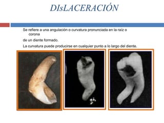 DIsLACERACIÓN
Se refiere a una angulación o curvatura pronunciada en la raíz o
corona
de un diente formado.
La curvatura puede producirse en cualquier punto a lo largo del diente.
 