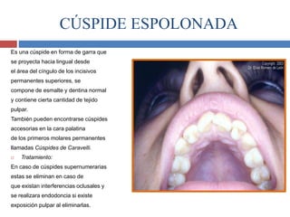 CÚSPIDE ESPOLONADA
Es una cúspide en forma de garra que
se proyecta hacia lingual desde
el área del cíngulo de los incisivos
permanentes superiores, se
compone de esmalte y dentina normal
y contiene cierta cantidad de tejido
pulpar.
También pueden encontrarse cúspides
accesorias en la cara palatina
de los primeros molares permanentes
llamadas Cúspides de Caravelli.
 Tratamiento:
En caso de cúspides supernumerarias
estas se eliminan en caso de
que existan interferencias oclusales y
se realizara endodoncia si existe
exposición pulpar al eliminarlas.
 