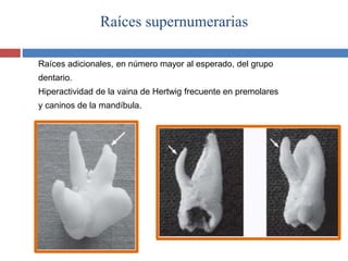 Raíces supernumerarias
Raíces adicionales, en número mayor al esperado, del grupo
dentario.
Hiperactividad de la vaina de Hertwig frecuente en premolares
y caninos de la mandíbula.
 