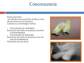 Concrescencia
Forma de fusión
Los dientes se encuentran unidos a nivel
de las raíces por el cemento.
Conserva su morfología normal.
 Concrescencia verdadera:
El proceso de fusión se produce durante
a odontogénesis.
 Concrescencia adquirida:
El proceso de fusión se produce una vez
que ha finalizado la
formación de las raíces.
 