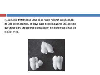 No requiere tratamiento salvo si se ha de realizar la exodoncia
de uno de los dientes, en cuyo caso debe realizarse un abordaje
quirúrgico para proceder a la separación de los dientes antes de
la exodoncia.
 