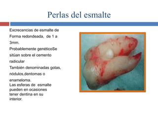 Perlas del esmalte
Excrecencias de esmalte de
Forma redondeada, de 1 a
3mm.
Probablemente genéticoSe
sitúan sobre el cemento
radicular
También denominadas gotas,
nódulos,dentomas o
enameloma.
Las esferas de esmalte
pueden en ocasiones
tener dentina en su
interior.
 