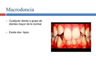 Macrodoncia
 Cualquier diente o grupo de
dientes mayor de lo normal.
 Existe dos tipos:
 