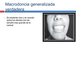 Macrodoncia generalizada
verdadera
 Es bastante rara y es cuando
todos los dientes son de
tamaño mas grande de lo
normal
 