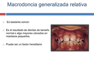 Macrodoncia generalizada relativa
 Es bastante común
 Es el resultado de dientes de tamaño
normal o algo mayores ubicados en
maxilares pequeños.
 Puede ser un factor hereditario
 