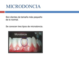 MICRODONCIA
Son dientes de tamaño más pequeño
de lo normal.
Se conocen tres tipos de microdoncia.
 
