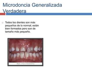 Microdoncia Generalizada
Verdadera
 Todos los dientes son más
pequeños de lo normal, están
bien formados pero son de
tamaño más pequeño.
 