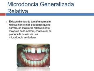 Microdoncia Generalizada
Relativa
 Existen dientes de tamaño normal o
relativamente más pequeños que lo
normal, en maxilares relativamente
mayores de lo normal, con lo cual se
produce la ilusión de una
microdoncia verdadera.
 