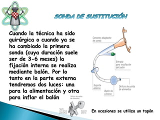 Cuando la técnica ha sido quirúrgica o cuando ya se ha cambiado la primera sonda (cuya duración suele ser de 3-6 meses) la fijación interna se realiza mediante balón. Por lo tanto en la parte externa tendremos dos luces: una para la alimentación y otra para inflar el balón En ocasiones se utiliza un tapón 