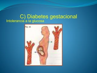 C) Diabetes gestacional
Intolerancia a la glucosa
 