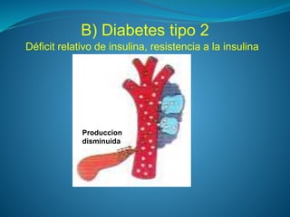 B) Diabetes tipo 2
Déficit relativo de insulina, resistencia a la insulina
Produccion
disminuida
 