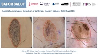 Application domains: Detection of patterns / clues in tissues, delimiting ROIs
Source: ISIC dataset https://www.isic-archi...