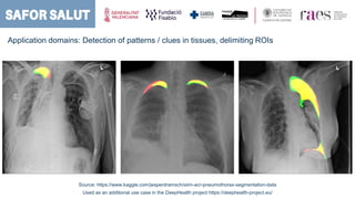 Application domains: Detection of patterns / clues in tissues, delimiting ROIs
Source: https://www.kaggle.com/jesperdramsc...