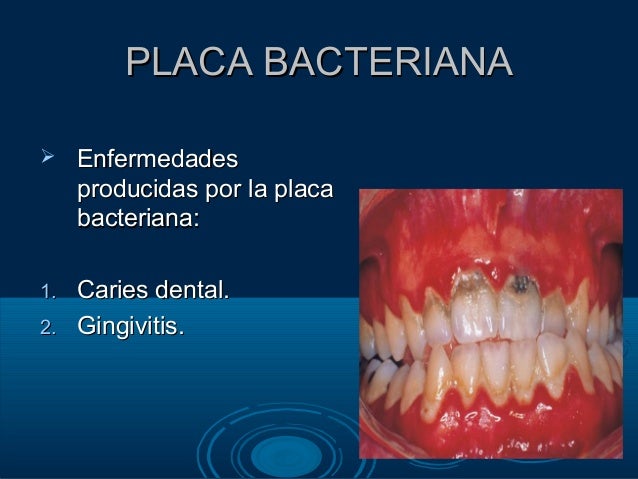 Placa bacteriana