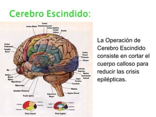 La Operación de
Cerebro Escindido
consiste en cortar el
cuerpo calloso para
reducir las crisis
epilépticas.
 