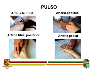 PULSO
Arteria femoral Arteria poplítea
Arteria tibial posterior Arteria pedíal
 