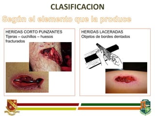 HERIDAS CORTO PUNZANTES
Tijeras – cuchillos – huesos
fracturados
HERIDAS LACERADAS
Objetos de bordes dentados
 