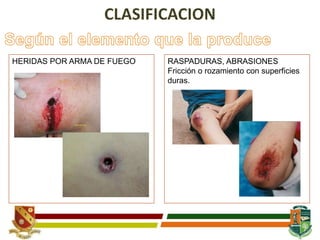 HERIDAS POR ARMA DE FUEGO RASPADURAS, ABRASIONES
Fricción o rozamiento con superficies
duras.
 