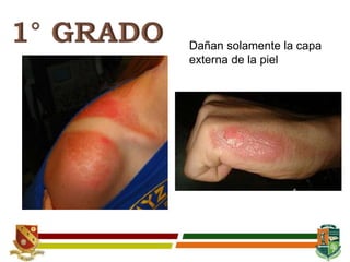 Dañan solamente la capa
externa de la piel
 