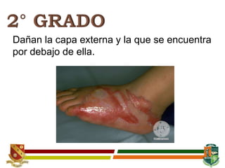 Dañan la capa externa y la que se encuentra
por debajo de ella.
 