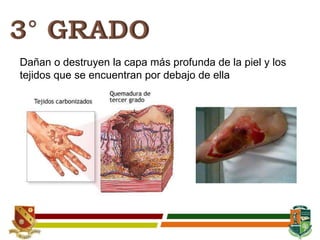 Dañan o destruyen la capa más profunda de la piel y los
tejidos que se encuentran por debajo de ella
 