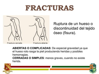 Ruptura de un hueso o
discontinuidad del tejido
óseo (fisura).
ABIERTAS O COMPLICADAS: De especial gravedad ya que
el hueso roto rasga la piel produciendo heridas y posibles
hemorragias.
CERRADAS O SIMPLES: menos graves, cuando no existe
herida.
 