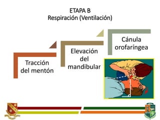 ETAPA B
Respiración (Ventilación)
Tracción
del mentón
Elevación
del
mandibular
Cánula
orofaríngea
 