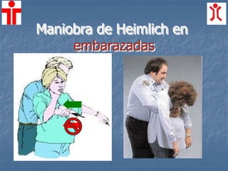 Maniobra de Heimlich en
embarazadas
 
