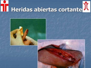 Heridas abiertas cortantes
 